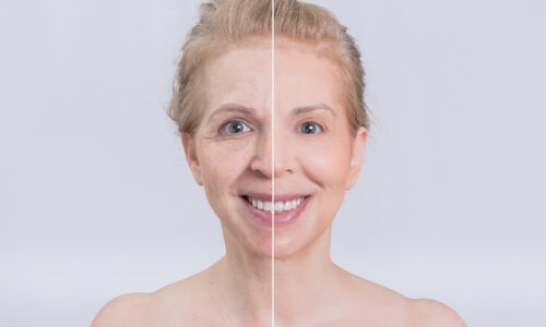 Results of anti wrinkle treatment