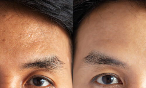 Forehead Anti Wrinkle treatment results image