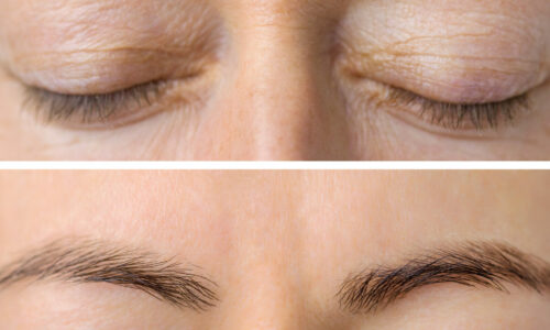 Anti Wrinkle treatment results image