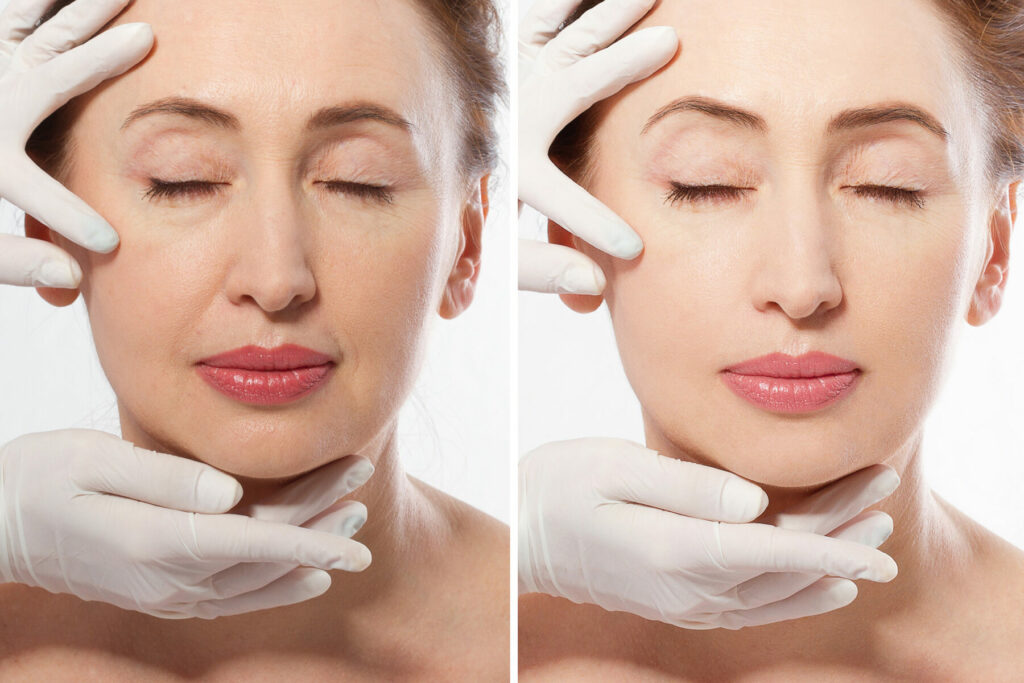 Before and after images of ladies face after anti-wrinkle treatment