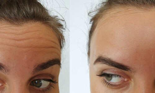 Before and after images of forehead wrinkle treatment