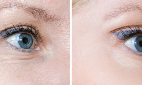 Before and after of under eye wrinkle treatment